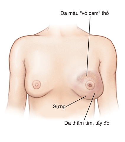 Hình phía trước ngực của người phụ nữ cho thấy vết xưng, da thô có màu vàng cam, da đỏ, thâm ở bên vú trái. Vú trái có núm vú bị đảo ngược. Vú phải bình thường.