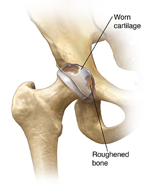 Hip joint, with worn cartilage on socket and roughened bone on ball.