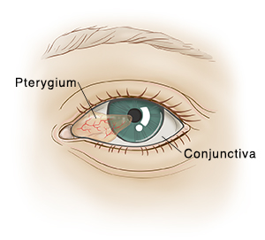 Front view of eye with clear tissue growing over white of eye and on to pupil.