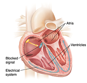 Cross section of heart showing electrical signal blocked at SA node.