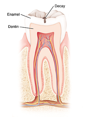 Cross section of tooth showing tooth decay.