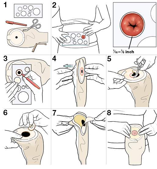 8 steps for sizing the opening of your stoma