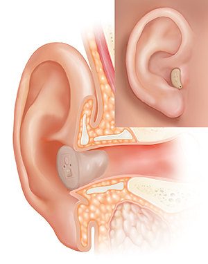 Cross section of ear showing outer, inner, and middle ear structures with in-the-canal hearing aid in place with inset of external view.