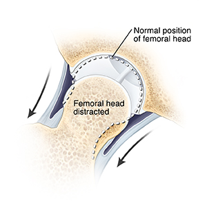 Cross section of hip joint with arrows showing femoral head of thighbone being pulled out of socket. Dotted line shows normal position of femoral head in socket.