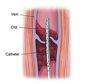 Cross section of muscle and varicose vein with blood clot. Catheter is inserted in vein through blood clot.