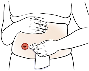 Female abdomen showing hands cleaning around stoma.