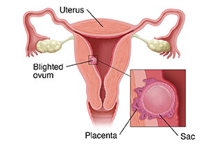 Cross section of female reproductive tract with inset showing blighted ovum.