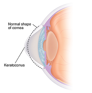 Side view cross section of eye with keratoconus. Dotted line shows normal shape of cornea.