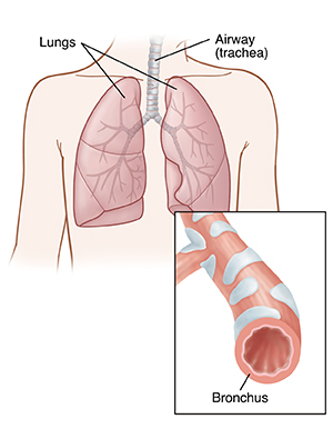 Front view of child's chest showing lungs. Inset shows cross section of bronchus.