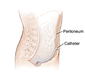 Side view of abdomen showing catheter inserted through body wall into abdominal cavity.