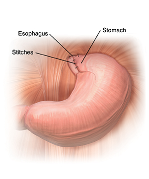 Closeup view of lower esphagus with top of stomach wrapped around it and stitched in place.