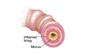 Clear airway compared to airway narrowed by inflamed lining and mucus.