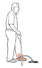 Man using cane, showing him step forward with affected leg and cane.