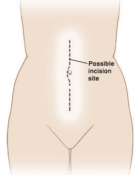 Outline of human figure with line in center of belly starting at top of belly, curving around belly button, and ending at bottom of belly.