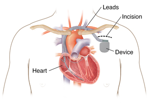 Outline of man's chest showing showing biventricular implantable cardioverter defibrillator device in chest with three leads going into heart chambers.