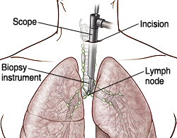 Front view of male chest showing mediastinoscopy.