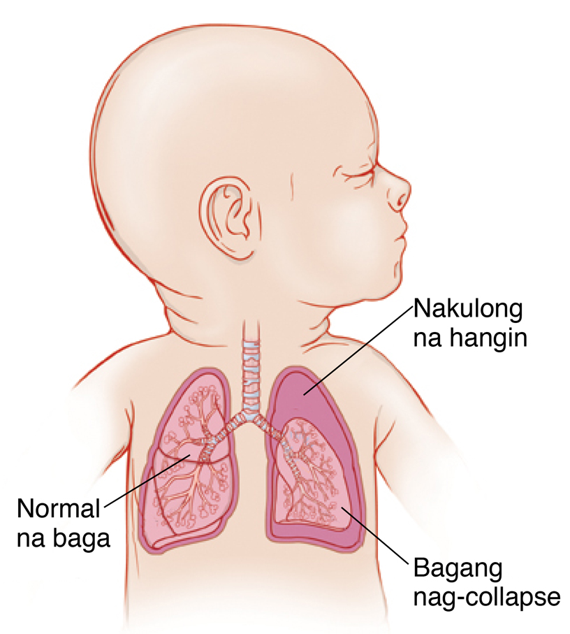 Closeup ng sanggol na may ulo sa naka-side nagpapakita panghimpapawid na daan at baga. Kaliwang baga ay nakulong naka palibot nito, at baga ay pinaliit.