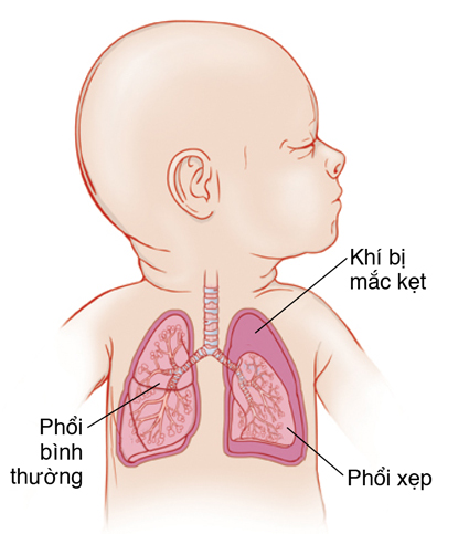 Cận cảnh đứa bé quay đầu sang bên cho thấy khí quản và phổi. Phổi trái có khí bị kẹt xung quanh và phổi xẹp.