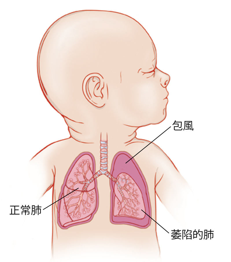 小孩頭轉向一側的略圖，顯示了氣管和肺部。左肺周圍有滯留空氣，肺萎陷。