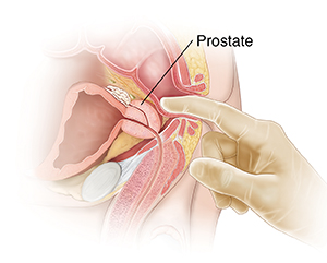 Side view of male pelvic organs showing digital rectal exam.