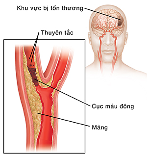 Cục máu làm nghẽn động mạch cảnh và cục máu bị vỡ ra thành các chất tắc mạch. Trang rời cho thấy tổn hại cho não.