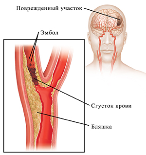 Кровяной сгусток, блокирующий сонную артерию, и эмболы, отрывающиеся от сгустка. Вставка показывает повреждение мозга.