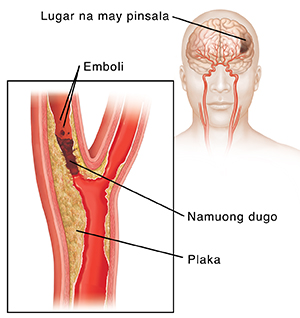 Pamumuo ng dugo na bumabara sa carotid artery at emboli na naghihiwalay sa pamumuo. Ipinapakita sa nakasingit na larawan ang pinsala sa utak.