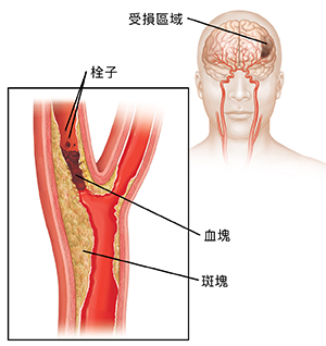 阻塞頸動脈的血凝塊與栓子的脫落凝塊。插圖顯示對大腦的傷害。