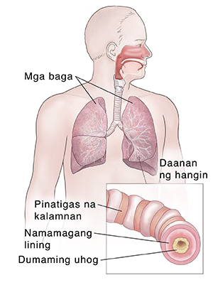 Harapang kuha ng lalaki na ipinakikita ang sistema ng palahingahan. Nakasingit na larawan na ipinakikita ang namamagang daanan ng hangin.