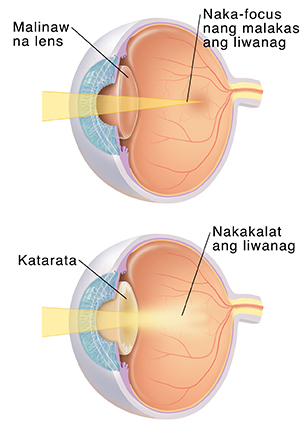 Three-quarter view ng mata na ipinakikita ang lente na matinding nagfo-focus ng liwanag. Three-quarter view ng mata na ipinakikita ang katarata na nagsasabog ng liwanag.