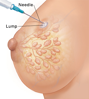 Side view of female breast with ducts and lobules ghosted in, showing needle biopsy of lump.