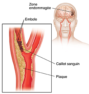 Un caillot sanguin bloquant l'artère carotide et des emboles se détachant du caillot. Image en médaillon des dommages au cerveau.