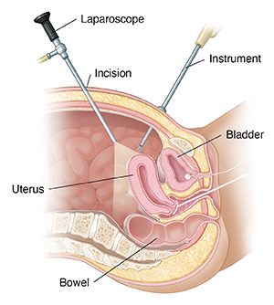 Cross section of female pelvis showing laparoscopy.