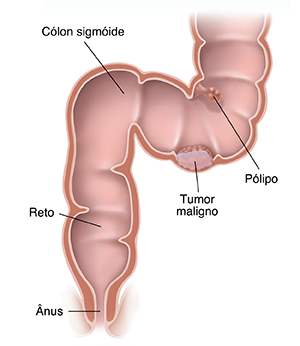 Corte transversal do cólon sigmoide, reto e ânus mostrando câncer e pólipo.