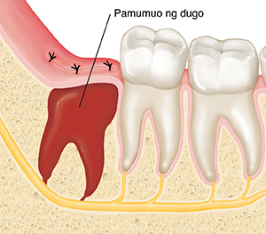 Closeup cross section ng buto sa panga at mga bagang na ipinakikita ang pamumuo ng dugo kung saan tinanggal ang wisdom tooth.