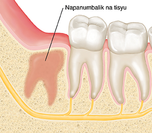 Malapitang cross section ng panga at mga bagang na ipinapakita ang pagsasaayos ng tisyu kung saan tinanggal ang wisdom tooth.