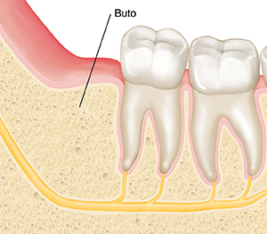 Malapitang cross section ng panga at mga bagang na ipinapakita ang buto kung saan tinanggal ang wisdom tooth.