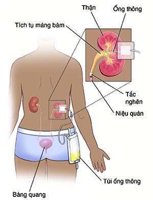 Mặt sau người cho thấy đường tiết niệu của họ với ống thận và túi ống thông tại chỗ. Trang rời cho thấy cận cảnh thận bị tắc nghẽn và ống thận.