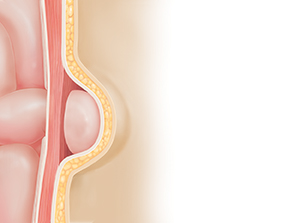 Cross section of body wall showing hernia. Intestine protruding through defect in muscle underneath skin.