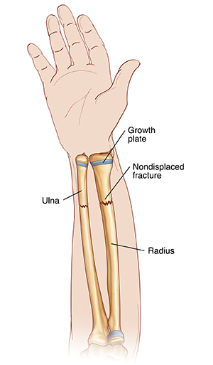 Palm view of hand and forearm showing radius and ulna. Nondisplaced fractures go across radius and ulna. Ends of bones are lined up. Growth plates are near wrist.