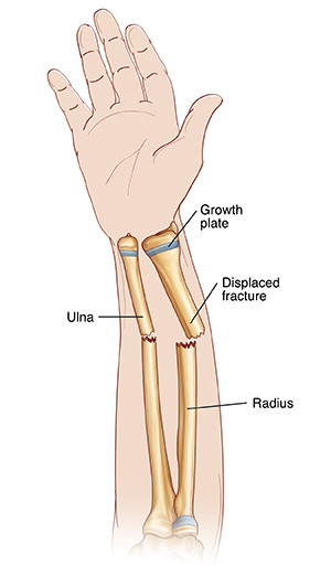 Palm view of hand and forearm showing radius and ulna. Displaced fractures go across radius and ulna. Ends of bones are not lined up. Growth plates are near wrist.