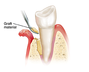 Tooth in cross section of gum and bone. Flap of gum exposes root of tooth and eroded bone. Instrument is placing graft material between bone and tooth.